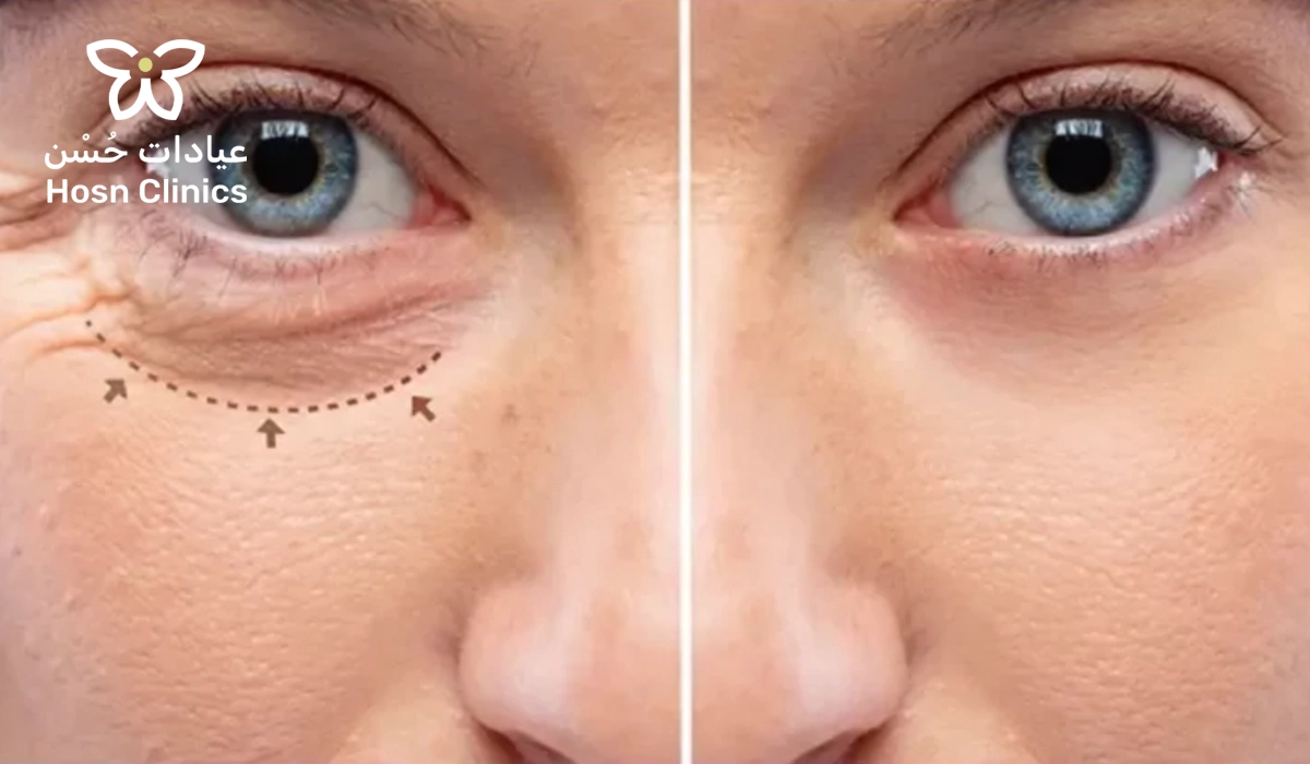 عملية قص الجفون السفلية: الحل النهائي لانتفاخ وترهل تحت العين في عيادات حُسْن